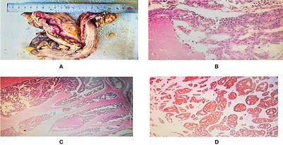 Immune-related keratitis is a rare complication associated with nivolumab treatment in a patient with advanced colorectal cancer: A case report